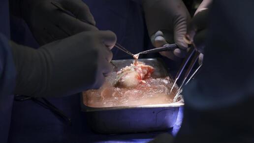Medizinische Sensation endet in Tragödie: Erster Empfänger einer Schweine-Niere gestorben