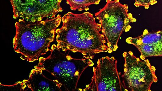 Moderna-Studie weckt Hoffnungen auf den weltweit ersten mRNA-Krebsimpfstoff